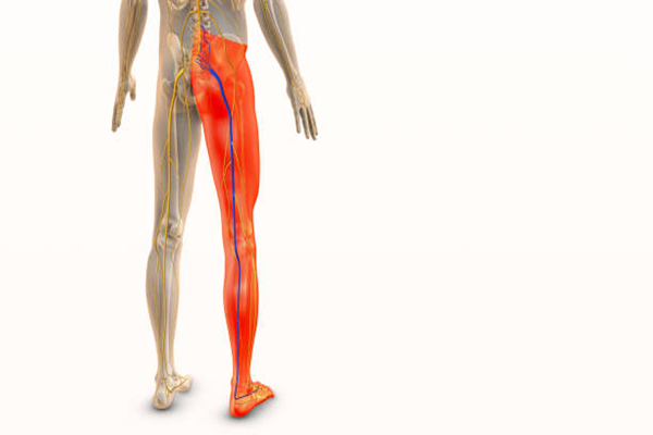 Is Sciatica Curable